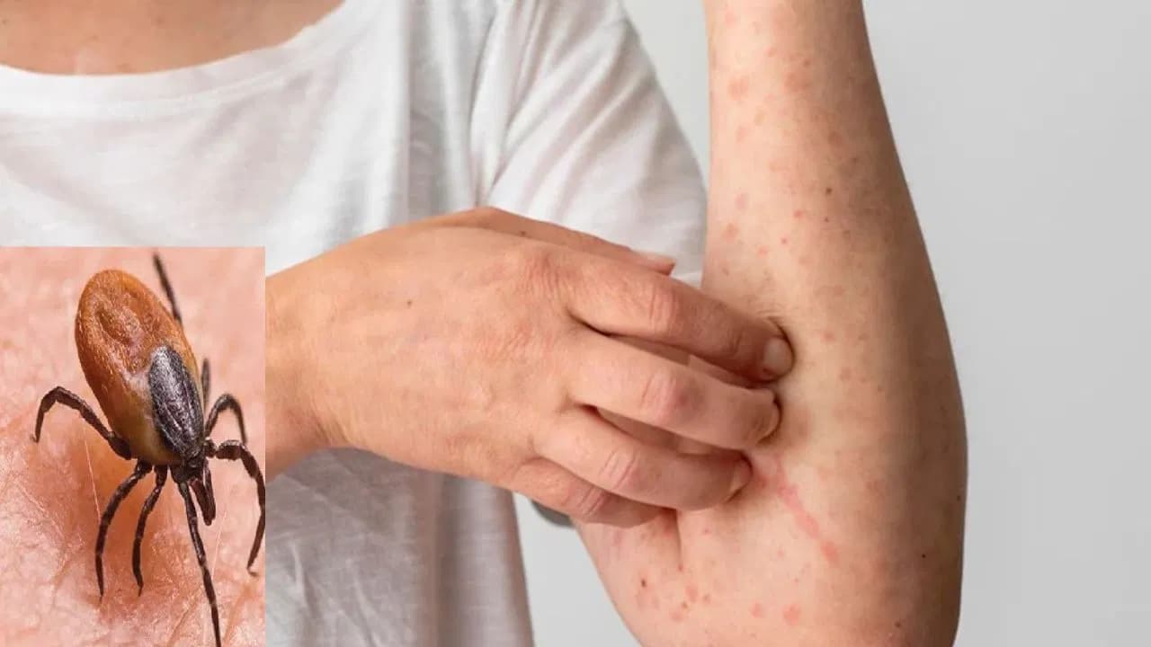 స్క్రబ్ టైఫస్ హెచ్చరిక: గుర్తించాల్సిన లక్షణాలు, తీసుకోవాల్సిన చర్యలు